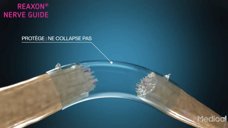 REAXON by KeriMedical — 3D animation highlighting the device's mode of action
